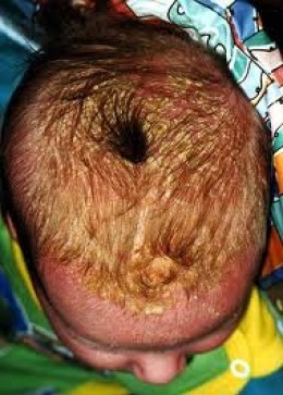 PEDIATRIC DERMATOSES