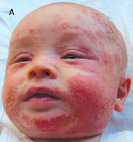 ECZEMA (DERMATITIS)