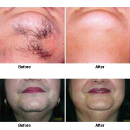 LASER FOR HAIR EPILATION (REDUCTION)