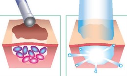 PHOTODYNAMIC THERAPY (PDT)