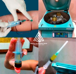 PLATELET-RICH PLASMA (PRP)