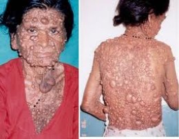 NEUROCUTANEOUS DERMATOSES (PHAKOMATOSES)