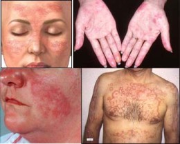 CONNECTIVE TISSUE DERMATOSES