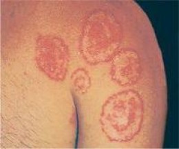 CUTANEOUS FUNGAL INFECTIONS