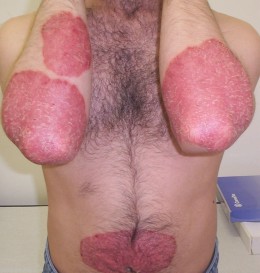 PAPULOSQUAMOUS DERMATOSES