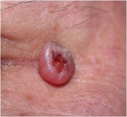 SKIN TUMORS