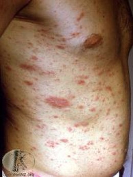  ERYTHEMATOUS LESIONS/RASH OF THE TRUNK AND LIMBS