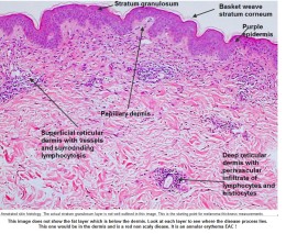 THE MACROSCOPY AND MICROSCOPY OF THE SKIN LESIONS